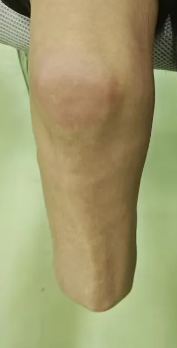 穿戴假肢后肌肉萎縮怎么辦？