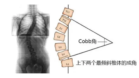 脊柱側(cè)彎角度怎么測量？