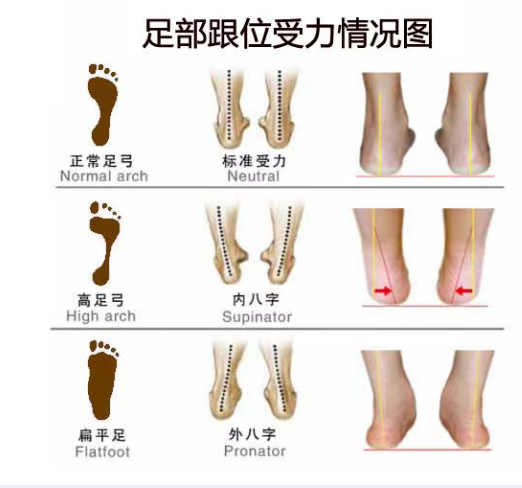 扁平足和脊柱側(cè)彎之間有關(guān)聯(lián)嗎？