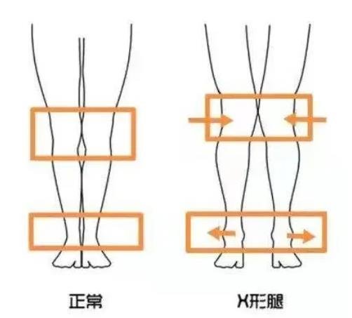膝關節(jié)外翻
