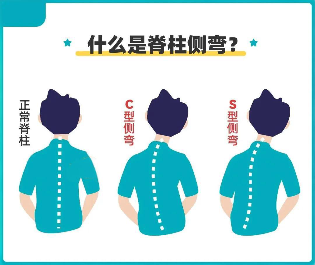 脊柱側(cè)彎與家庭自查