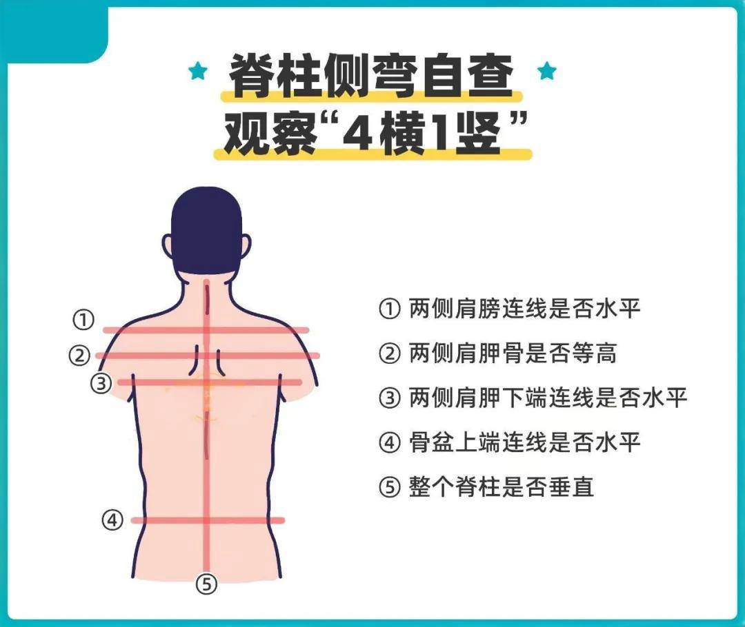 脊柱側(cè)彎與家庭自查