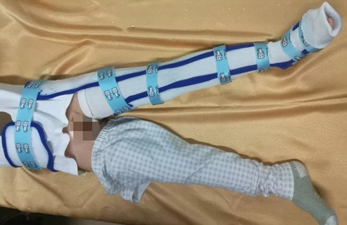 低溫板材在下肢骨折上的應(yīng)用