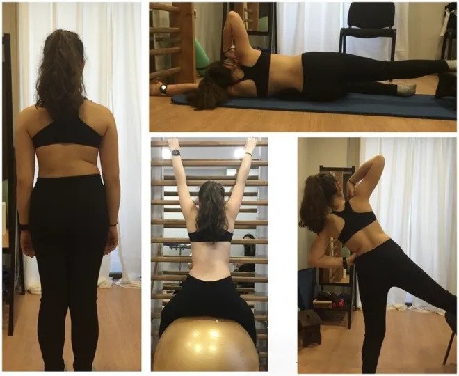 佩戴脊柱側彎矯形器后的運動治療