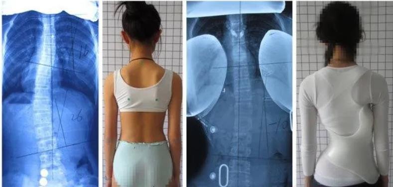 佩戴脊柱側彎矯形器后的運動治療